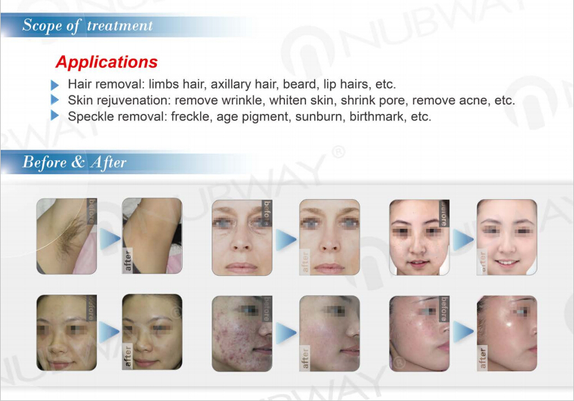 4 Treatment Scope of SHR.jpg