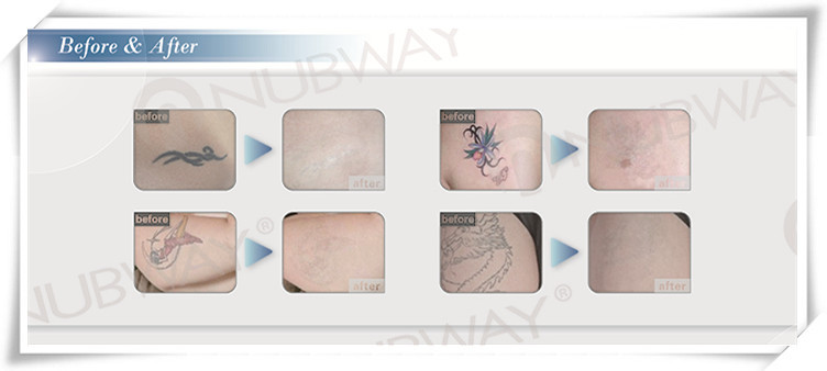Origin factory High quality portable mini tattoo removal laser machine for spa