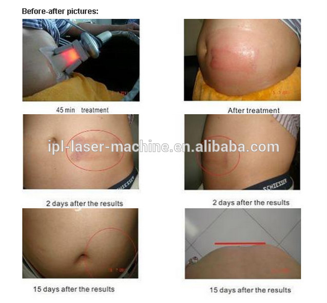 High Quality Body Shape Ultrasound Whole Body Slimming Fat Reduction Cryolipolysis Machine