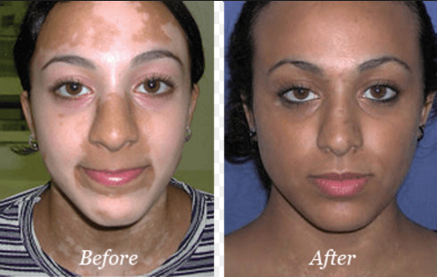 UVB Phototherapy Light Therapy Treatment For Psoriasis