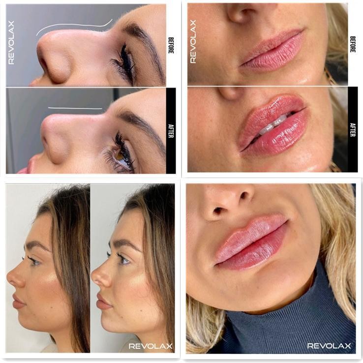 Fine Deep Sub-Q Cross Linked Hyaluronic Acid Dermal Filler Revolax
