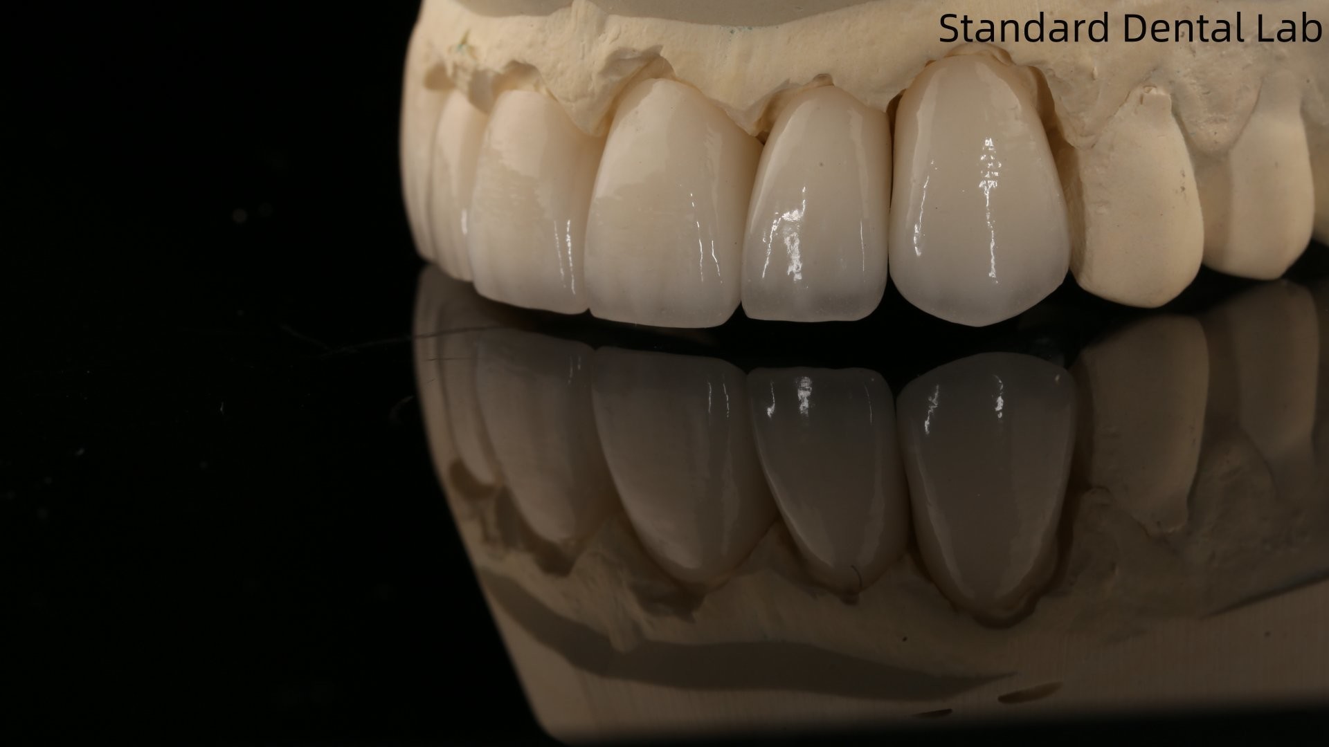 Full Contour Zirconia Crown and High Aesthetic Natural Dental Bridge 5 Year Guarantee