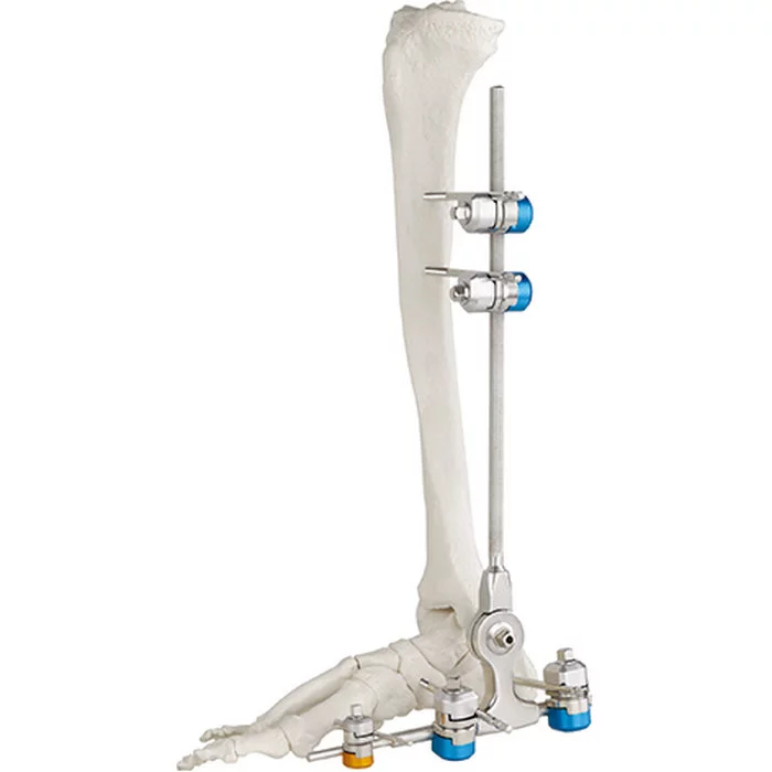 High Quality Bone Hammer Surgical Orthopedic Instrument Ankle Joint External Fixator Medical Instruments Bone Instrument