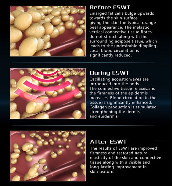 Salon Acoustic Wave Therapy Machine For Body Slimming Cellulite Reduce