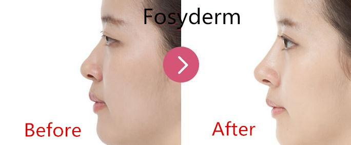 Hyaluronic Acid Injection Nose Dermal Filler , Hyaluronic Acid Gel Fillers