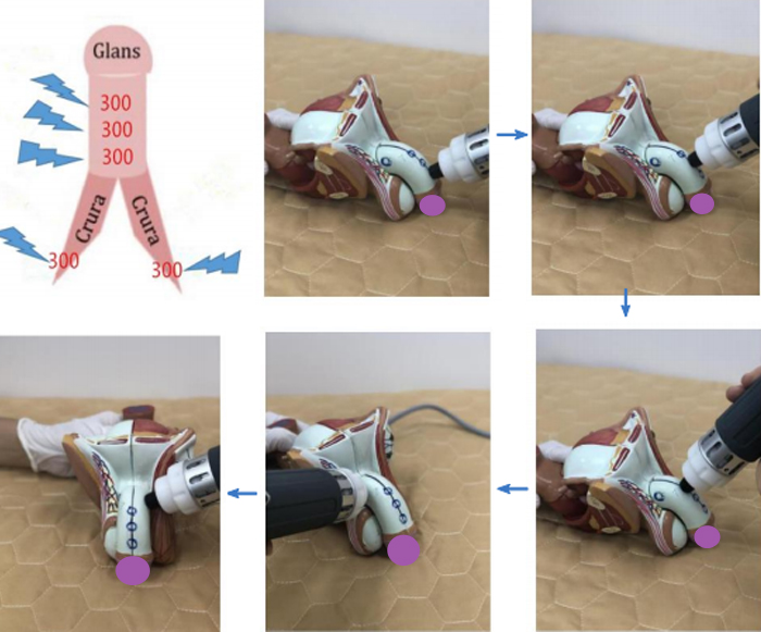 Extracorporeal Focused Shockwave Therapy Machine Portable For Pain Removal