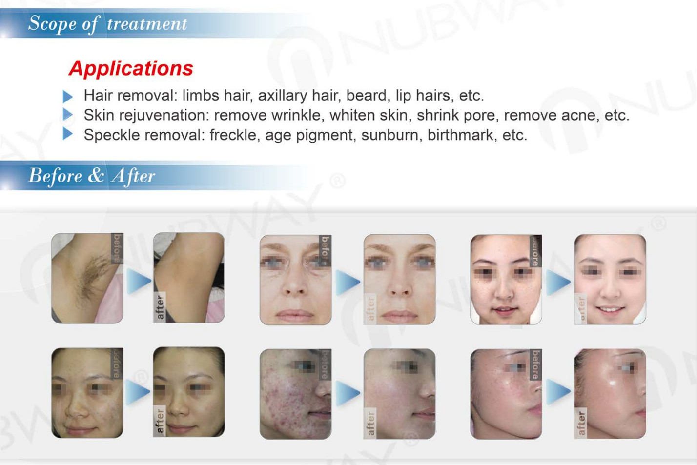 pulsed light professional shr ipl laser hair removal machine elight shr