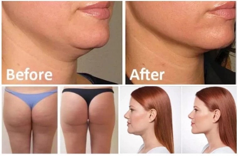 5*10 ml RED Ampoule Solution Lipo Lab Ppc Slimming Injectable