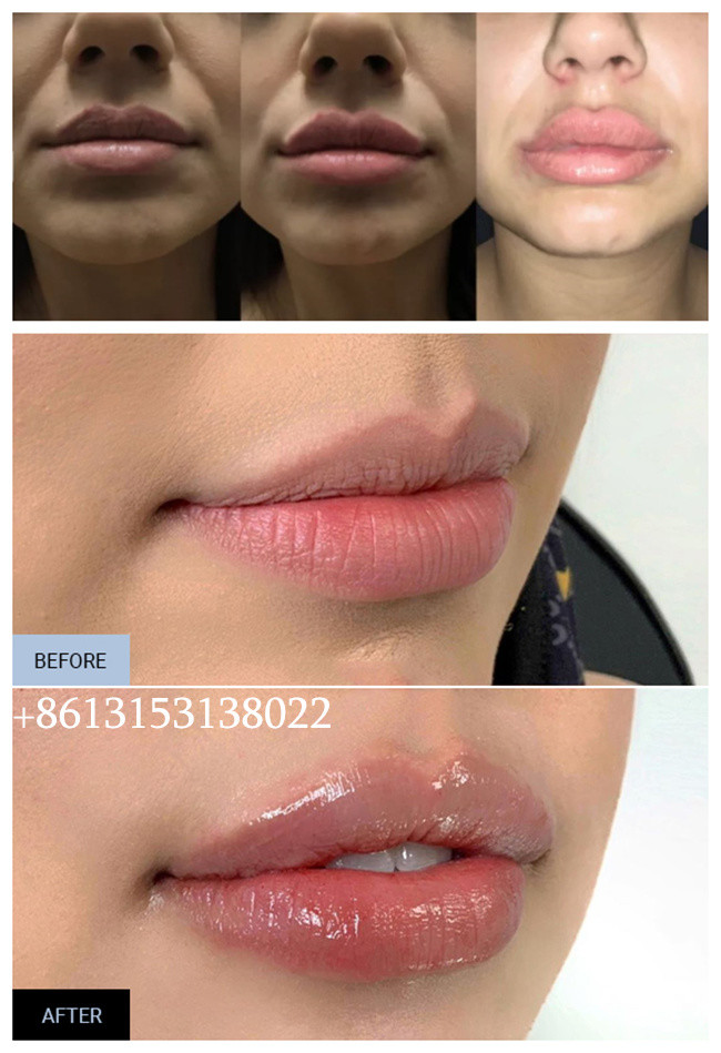Juvederm Hyaluronic Acid Facial Filler Long Lasting Ultra3 Ultra4 Voluma Injection