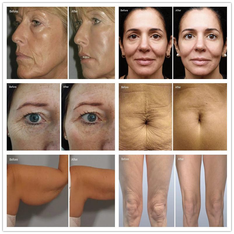Spa Light Therapy Skin Tightening Radio Frequency Device
