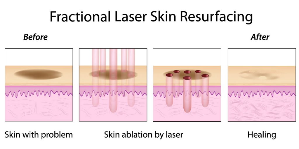Tightening Skin Fractional CO2 Laser Beauty Machine For Acne Pigment Scar Removal
