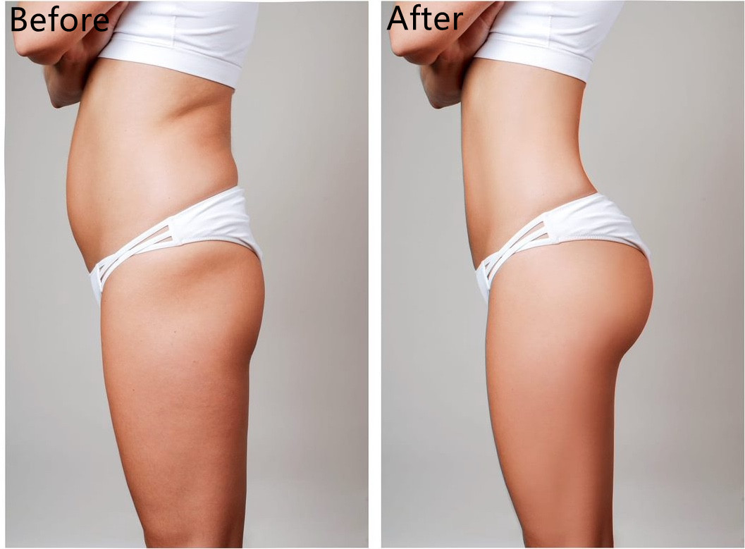 Hyaluronic Acid Breast Dermal Filler Breast Augmentation Buttock Lift Injection
