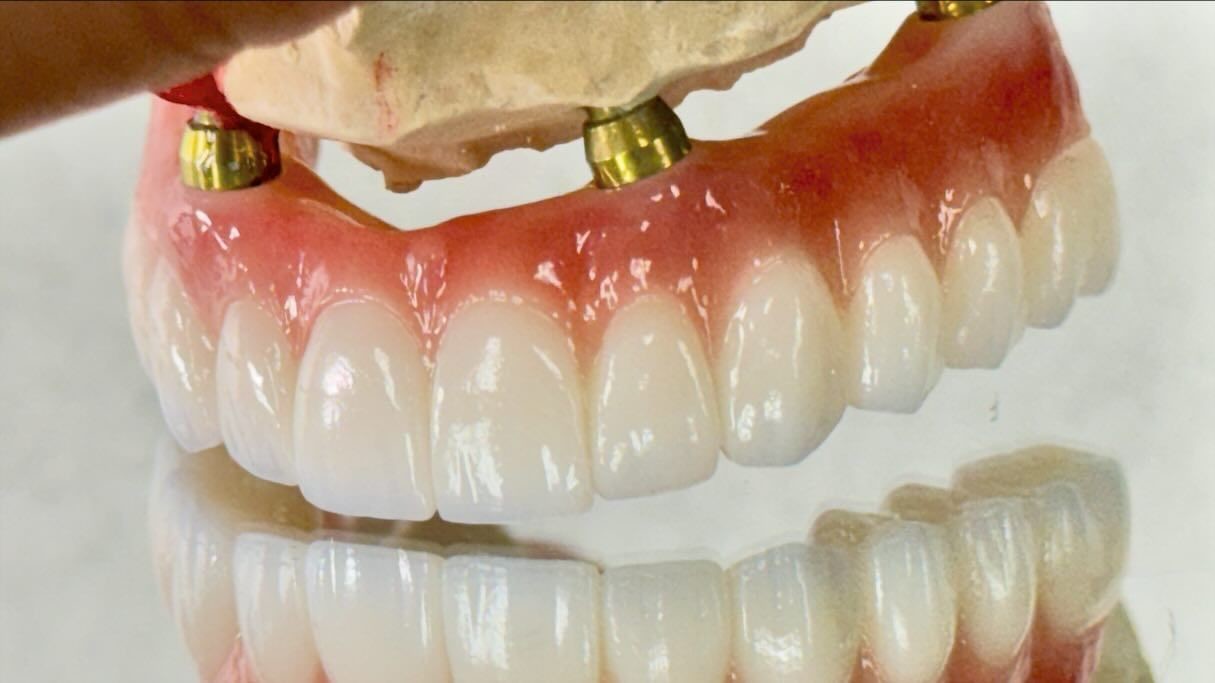 Dental All On X Implant PFM Crown Titanium Fixed Hybrid Denture