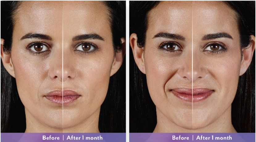 Juvederm Voluma Hyaluronic Acid Dermal Filler Prefilled Injection Gel