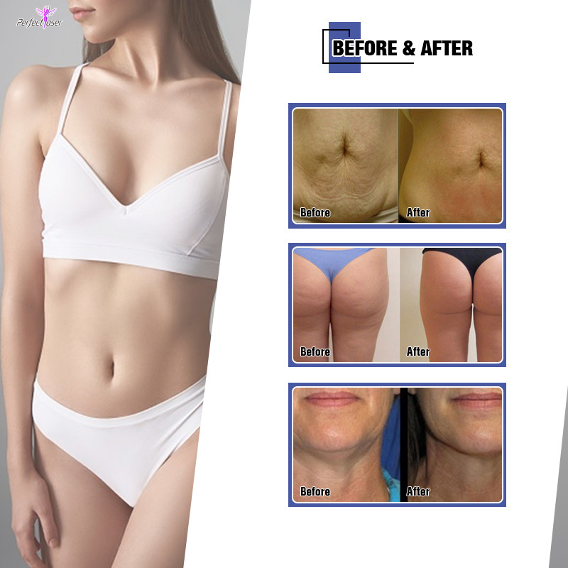 Body Shaping Sculpting Vela Equipment Weight Loss Beauty For Salon