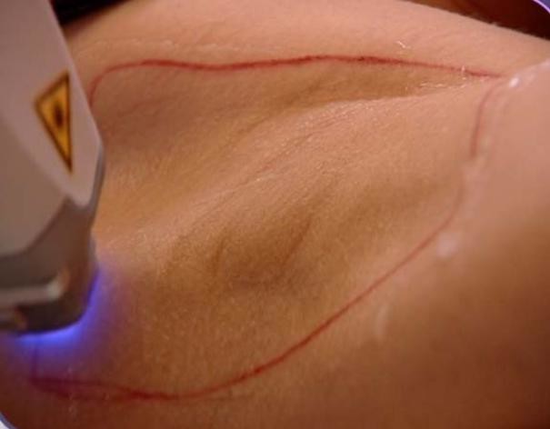 800W Laser Hair Removal Permanent Machine Commercial Skin Rejuvenation