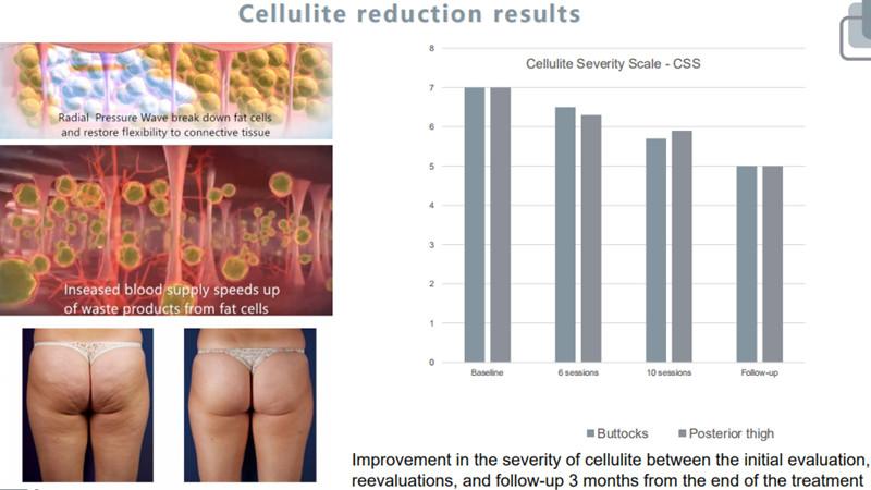 Vacuum Shock Wave Physiotherapy Machine For Cellulite Reduction
