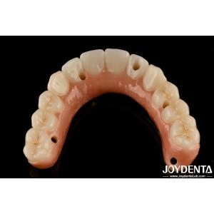 Natural Teeth And Gums Compatible Ti-Bar Zirconia Hybrid Bridge With High