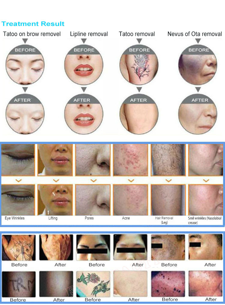 12000W Yag Laser Machine Skin Whitening Pigment Removal Equipment
