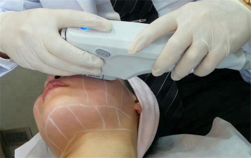 3 Cartridge Portable Hifu Device Anti Wrinkle Skin Lifting And Tightening