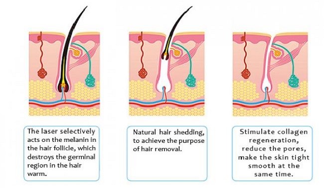 800W Laser Hair Removal Permanent Machine Commercial Skin Rejuvenation